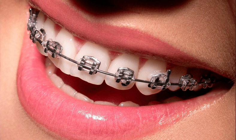 Улучшение прикуса: Как брекеты влияют на ортодонтическое лечение